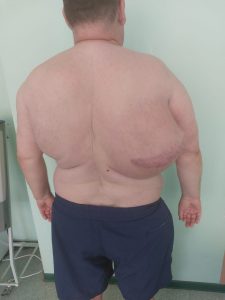 Хирурги Раменской ОБ удалили липому весом более 10 кг