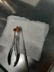 Раменские врачи извлекли из носа ребенка косточку миндаля