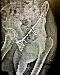 Врачи Раменской областной больницы поставили на ноги мужчину после неудачного падения