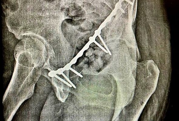 Врачи Раменской областной больницы поставили на ноги мужчину после неудачного падения