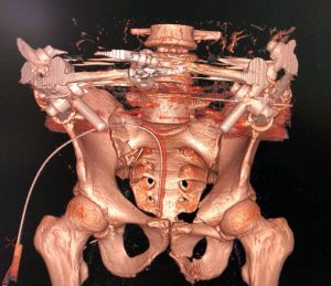 Раменские врачи спасли жизнь мужчине с многочисленными переломами костей таза